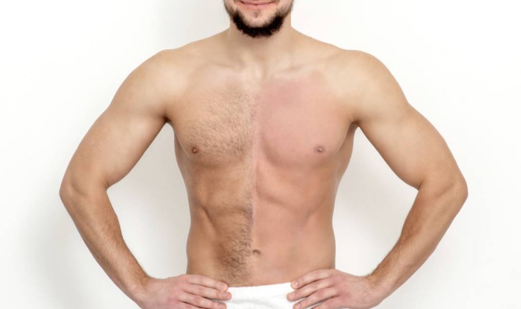 Épilation laser homme
