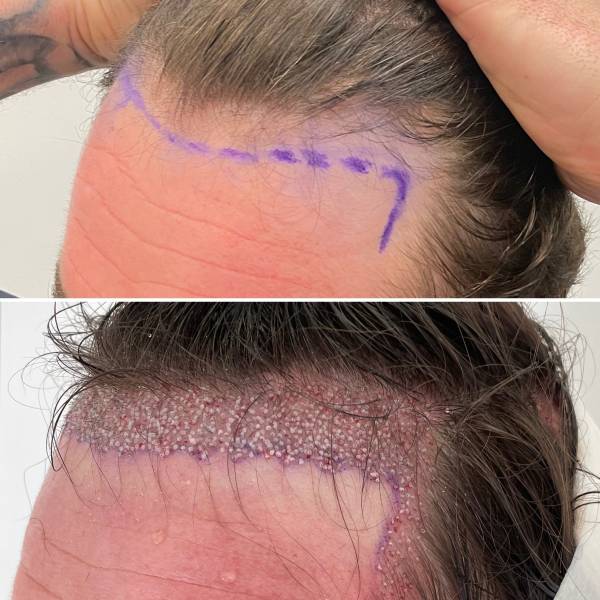 greffe de cheveux avant après implants de 2500 greffons avec la méthode DHI