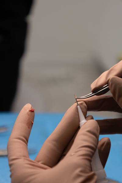 Insertion d'un greffon dans un choï pour une greffe capillaire méthode DHI à Marseille proche de Cassis 