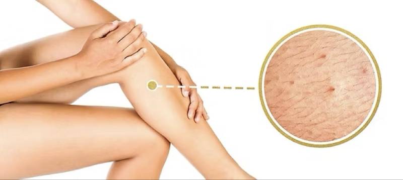 Épilation laser pour poils incarnés à Marseille 13008 Périer : traitement ciblé pour une peau plus nette, saine et sans irritation durablement.