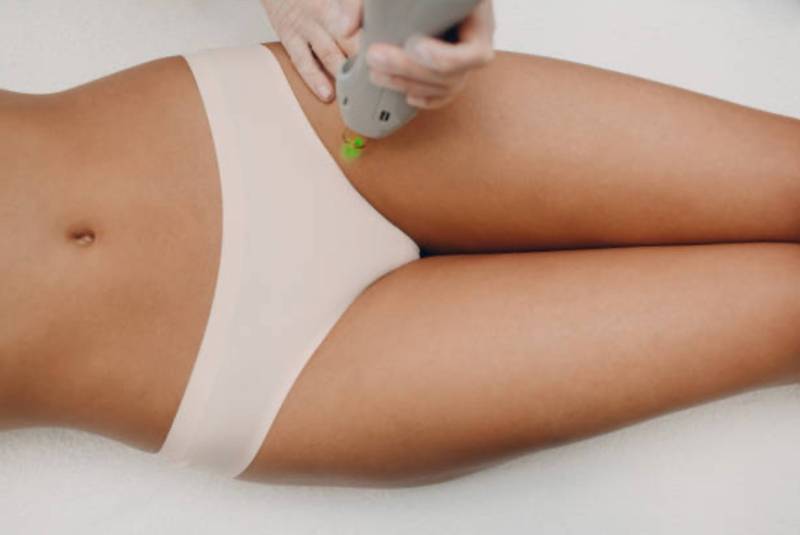 Épilation laser femme du maillot intégral à Marseille 13007 Endoume pour améliorer le confort au quotidien.