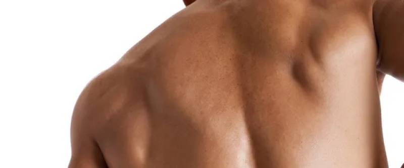 Épilation laser homme épaules et haut du dos à Marseille 13004 pour supprimer les démarcations et lisser la pilosité