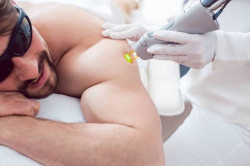 Épilation laser homme des épaules très poilues à Marseille 13009 Le Cabot avec protocole personnalisé.