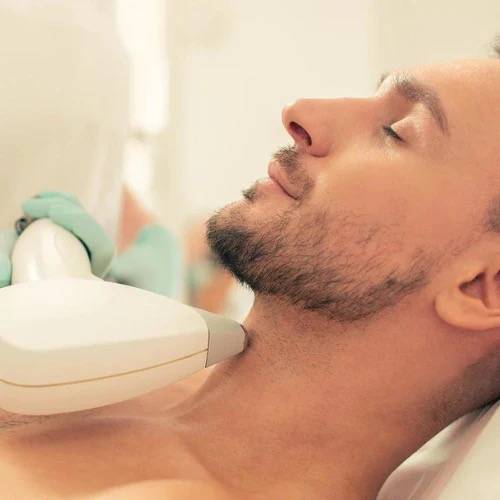 Traitement d’épilation laser de la nuque chez l’homme chez EREV Capillaire & Laser pour éliminer les poils incarnés et obtenir une finition nette.