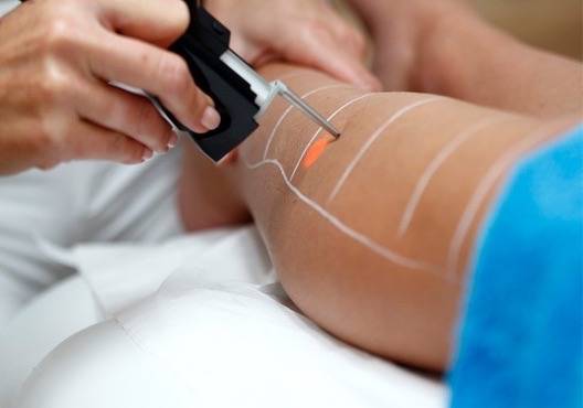 Épilation laser femme cuisses à Marseille 13010 Saint-Loup pour affiner la pilosité et obtenir un rendu esthétique naturel durable avec une peau nette et homogène.