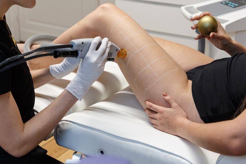 Épilation laser femme intérieur des cuisses à Marseille 13008 pour limiter les frottements et obtenir une peau douce et uniforme.
