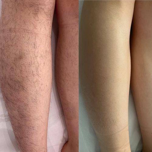 Épilation laser femme arrière des cuisses à Marseille 13009 Mazargues pour affiner la pilosité et améliorer l’esthétique des jambes durablement avec un rendu naturel.
