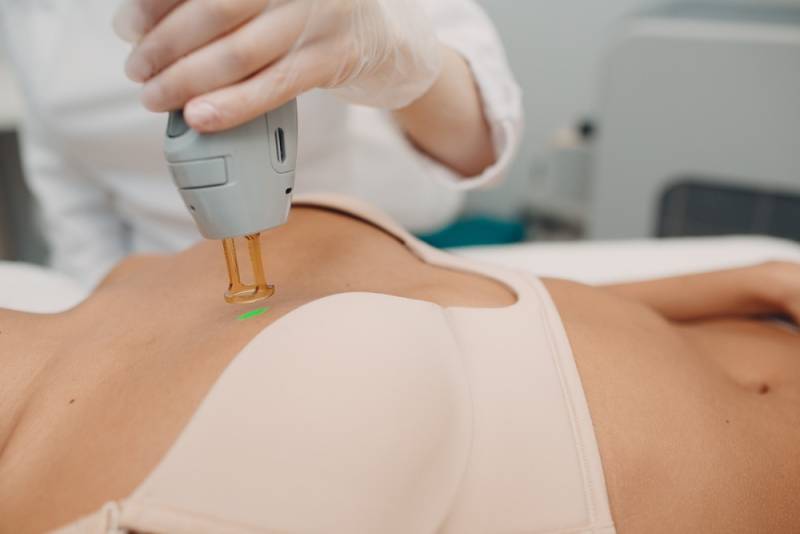 Épilation laser femme aréoles des seins à Marseille 13010 Saint-Loup pour traiter la pilosité hormonale en toute sécurité et retrouver une peau nette.