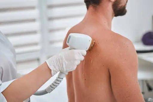 Épilation laser homme torse et épaules à Marseille Mazargues 13009 pour réduire la pilosité et structurer le buste avec un rendu naturel.