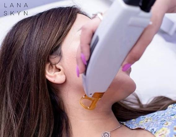 Traitement d’épilation laser du visage pour pilosité hormonale chez la femme chez EREV Capillaire & Laser à Marseille 13006 Castellane. 