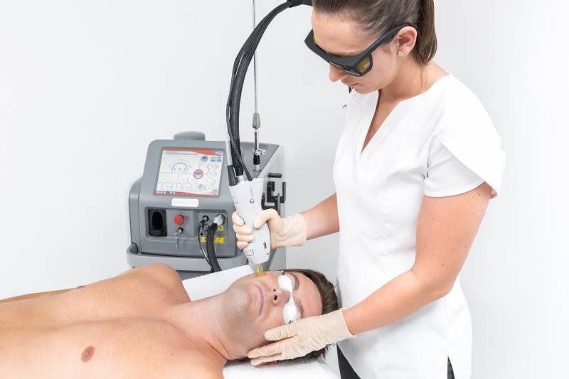 Épilation laser homme pommettes à Cassis pour structurer le visage et réduire la pilosité faciale avec un rendu net et naturel.