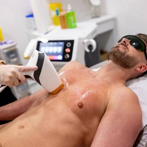 Traitement d’épilation laser du torse et de l’abdomen chez EREV Capillaire & Laser à Marseille 13008 Bonneveine pour réduire durablement la pilosité masculine.
