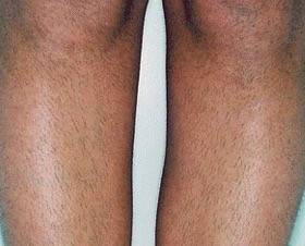 Épilation laser homme jambes entières à Marseille 13005 Baille pour améliorer le confort et réduire la pilosité durablement