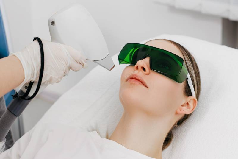 Épilation laser du visage traitement précis des poils hormonaux du menton