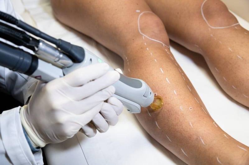 Épilation laser femme genoux et mollets à Marseille 13012 pour une peau lisse durablement et une épilation homogène.