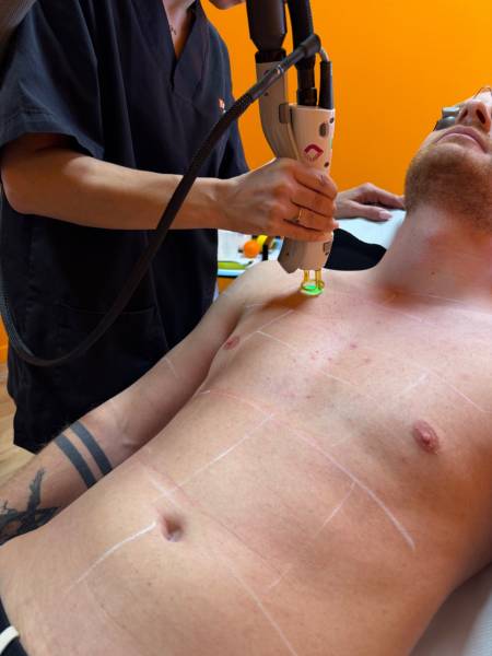 Épilation laser du torse : précision, sécurité et résultats durables.