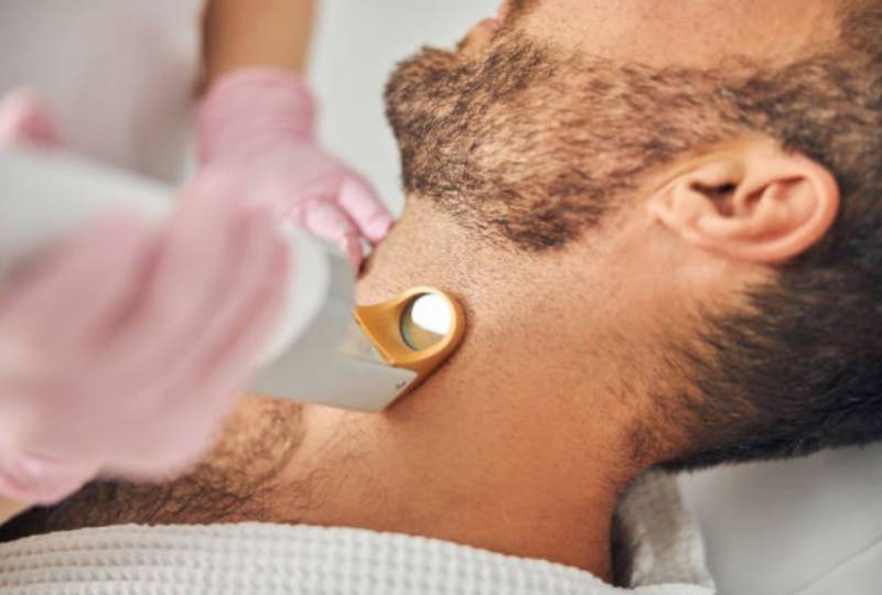 Épilation laser du cou et de la barbe : solution idéale pour éliminer les poils incarnés et redessiner les contours durablement.