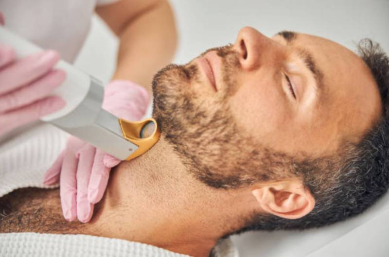 Épilation laser de la barbe : précision, confort et résultats durables.